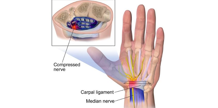 6 wrist pain exercises